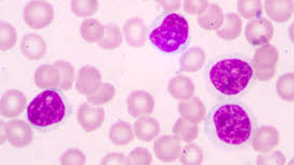 Kronik Lenfositer Lösemi ve Foliküler Lenfoma Hastalarında Zanubrutinib (BGB-3111) Obinutuzumab Kombinasyonu Sonuçları